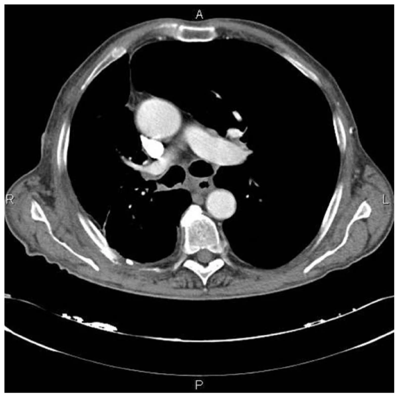CT plic měsíc po IRE
Fig. 4: Lung CT one month after IRE – approximately 98% tumour mass reduction is seen