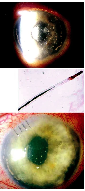 Cizí nitrooční těleso imitující pooperační endoftalmitidu u 72leté pacientky. A) Špekovité precipitáty na endotelu rohovky a fibrin v přední komoře levého oka, nález 4 týdny po operaci katarakty. B) Histopatologické vyšetření vzorku tekutiny z přední komory a vlasovitého útvaru prokázalo, že se jedná o řasu