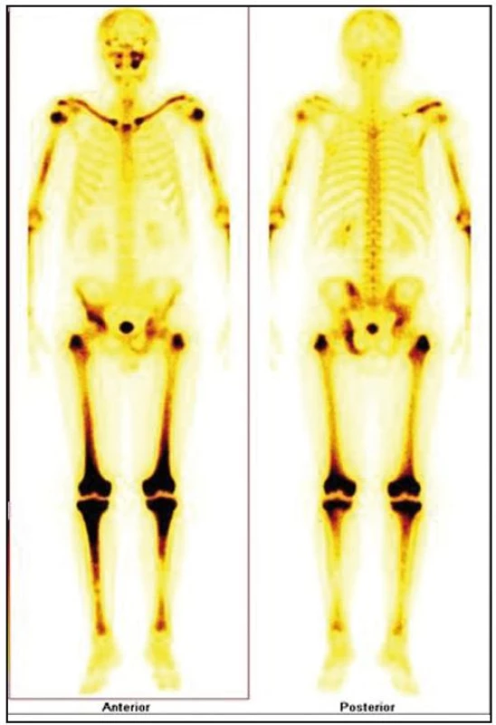 Scintigrafie skeletu: zvýšená aktivita radiofarmaka je vidět hlavně ve dlouhých kostech – oba humery ve střední třetině, v distálních částech obou femorů, v proximálních částech obou tibií, v obou klavikulách, v oblasti pánve – os ischii vlevo, os pubis vpravo, os ilium vpravo, v oblasti levého SI skloubení, dále v oblasti maxily vlevo, difuzně vyšší aktivita v oblasti kalvy s ložisky vpravo parietálně a částečně frontálně bilaterálně.