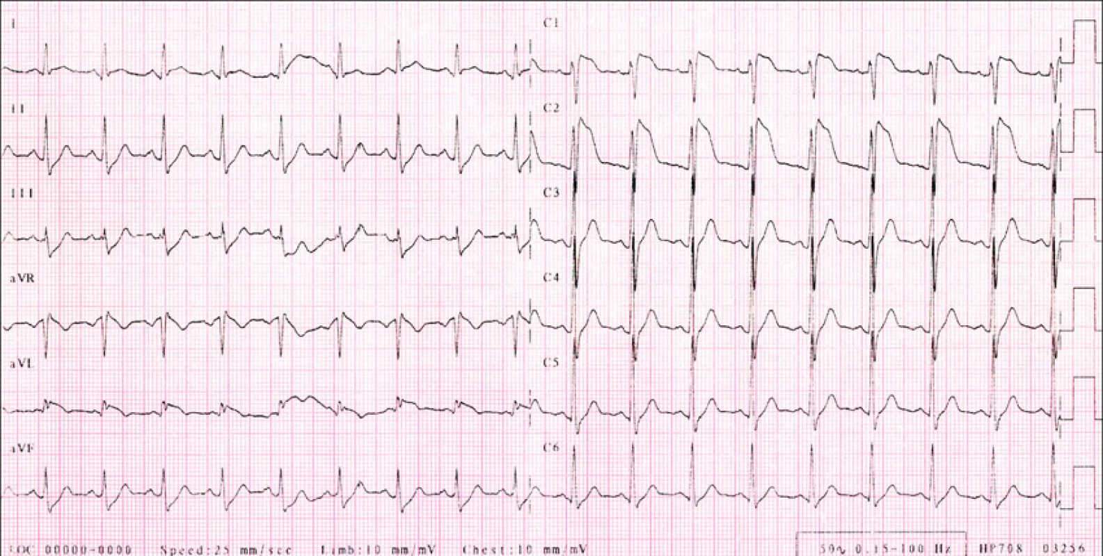 RK, 29 let, Brugada syndrom.
EKG s vysoko odstupujícími konkávními elevacemi ST segmentu (J vlna) ve V1,2.