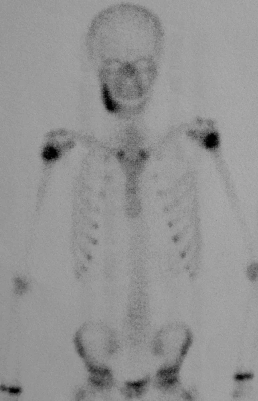 Scintigrafie skeletu před léčbou