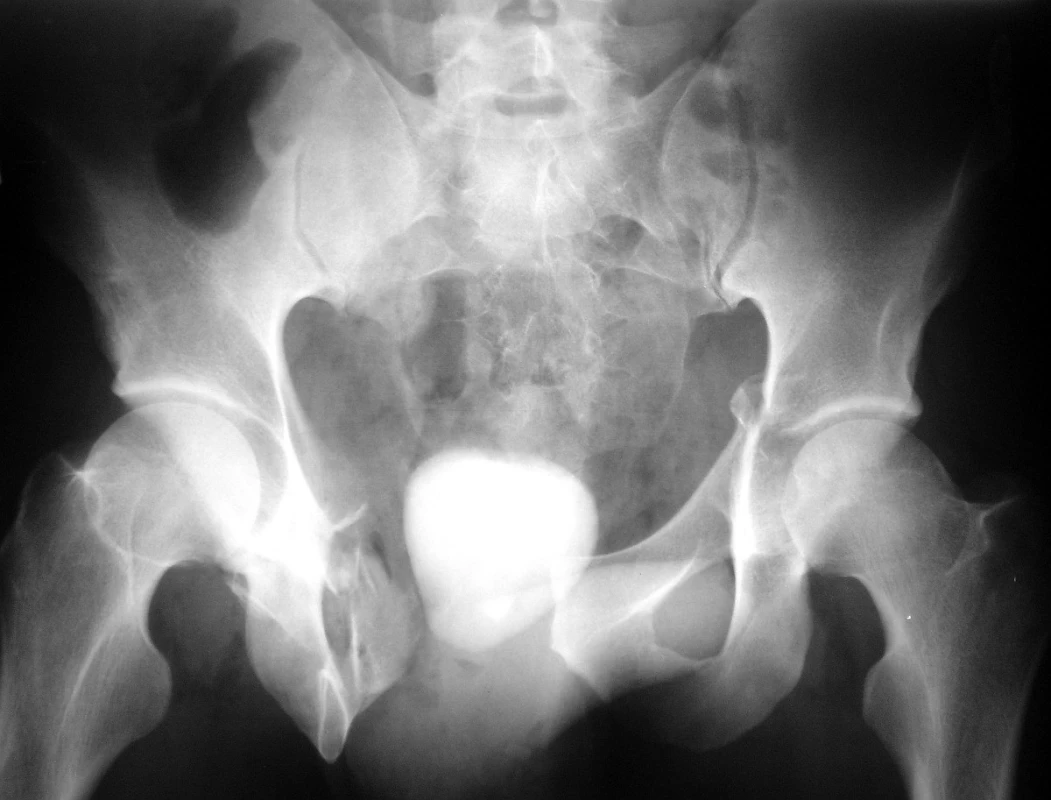 RTG snímek pánve 24letého pacienta s nálezem transforaminální zlomeniny sakra vpravo, zlomeninou laterální části stydkých ramének vpravo, symfyzeolýzou s rozestupem o 6 cm a zlomeninou horního raménka stydké kosti vlevo zasahující do oblasti předního pilíře acetabula bez dislokace. Kontrastní náplň měchýře nesvědčí pro jeho významné poranění, avšak výraznější stín 2 cm nad ústím uretry poněkud vlevo odpovídá peroperačně nalezené lézi přední stěny měchýře