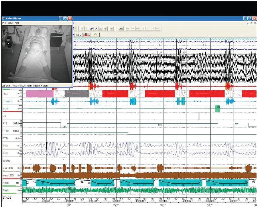 Pětiminutová část záznamu videopolysomnografie – v levém rohu záznamu je na obrazovce pacient, který je snímán kamerou v infračerveném světle. První dva řádky jsou záznam EOG, níže pak záznam EEG (zvýrazněné červené čáry značí mikroprobuzení). Následuje řádek průtoku vzduchu (flow) s patrnými zástavami dechu – apnoickými pauzami (červeně značené obdélníky). Mezi apnoickými pauzami je modře značeno chrápání. V dolní části záznamu je modrozeleně zvýrazněn pokles saturace krve kyslíkem – patrný pokles až na 62 % SaO&lt;sub&gt;2&lt;/sub&gt;.