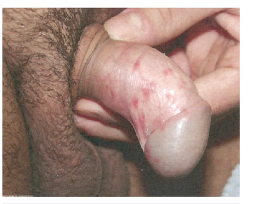 Herpes genitalis (použito se svolením prof. MUDr. K. Pizingera, CSc.)
Fig. 3. Herpes genitalis (used with permission of Prof. K. Pizinger, MD, PhD)