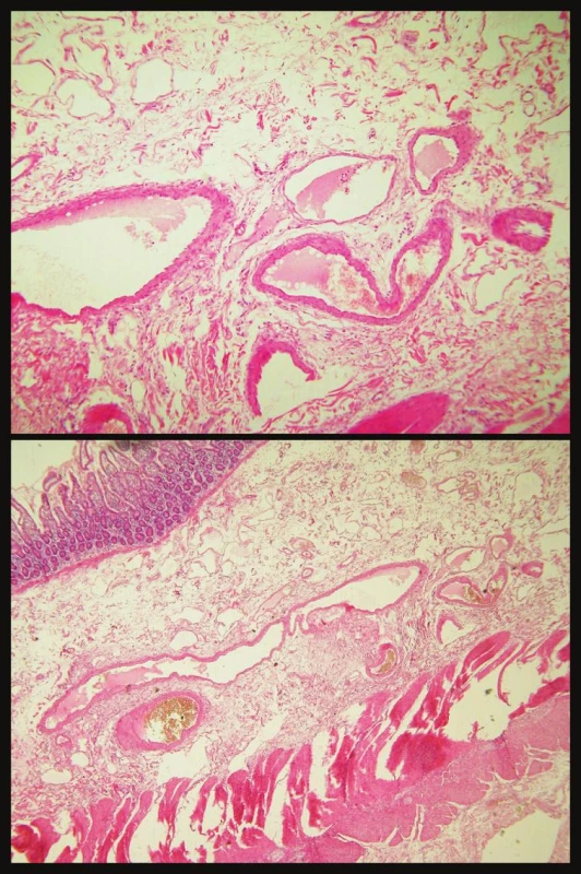 Histologický obraz angiodysplázie
Fig. 3. Histological view of angiodysplasia