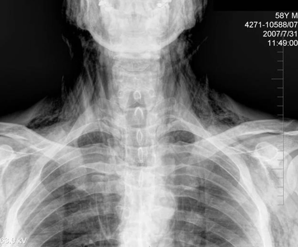 Rentgenový snímek HHA
Fig. 4. X-ray of the upper chest-aperture