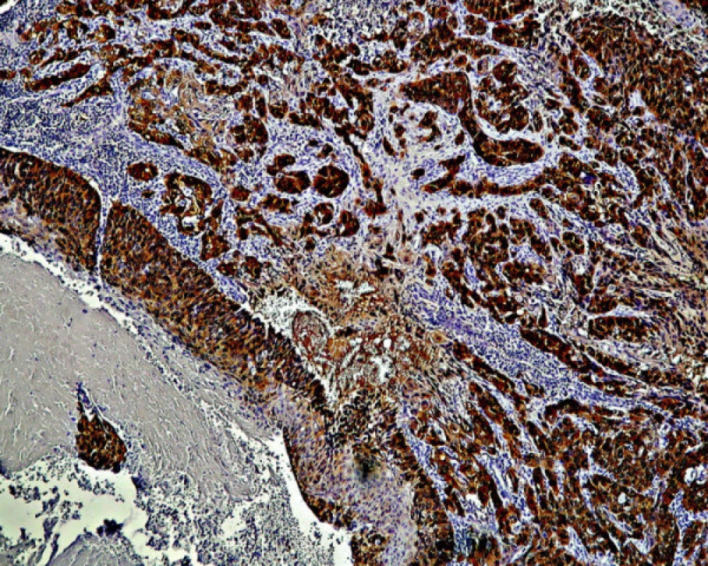 Invazívny rast karcinómu krčka maternice s rozsiahlou pozitivitou farbenia na antigén p16. Zväčš. 120x