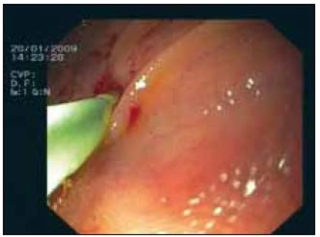 Endoskopický obraz – úspěšná kanylace stenotického ústí HJA (s následnou úspěšnou kanylací nasedajících žlučových cest).