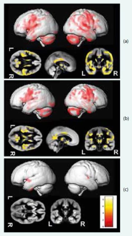 Srovnání schizofrenních a kontrolních osob vykazuje nezávisle na přítomnosti latentní toxoplazmózy významnou redukci objemu šedé hmoty u schizofrenních osob (a), rozdíl mezi pacienty a kontrolami byl vice vyjádřen u Toxoplasma gondii pozitivních nemocných (b) nežli v případě srovnání neinfikovaných (c). Upraveno podle [9]
