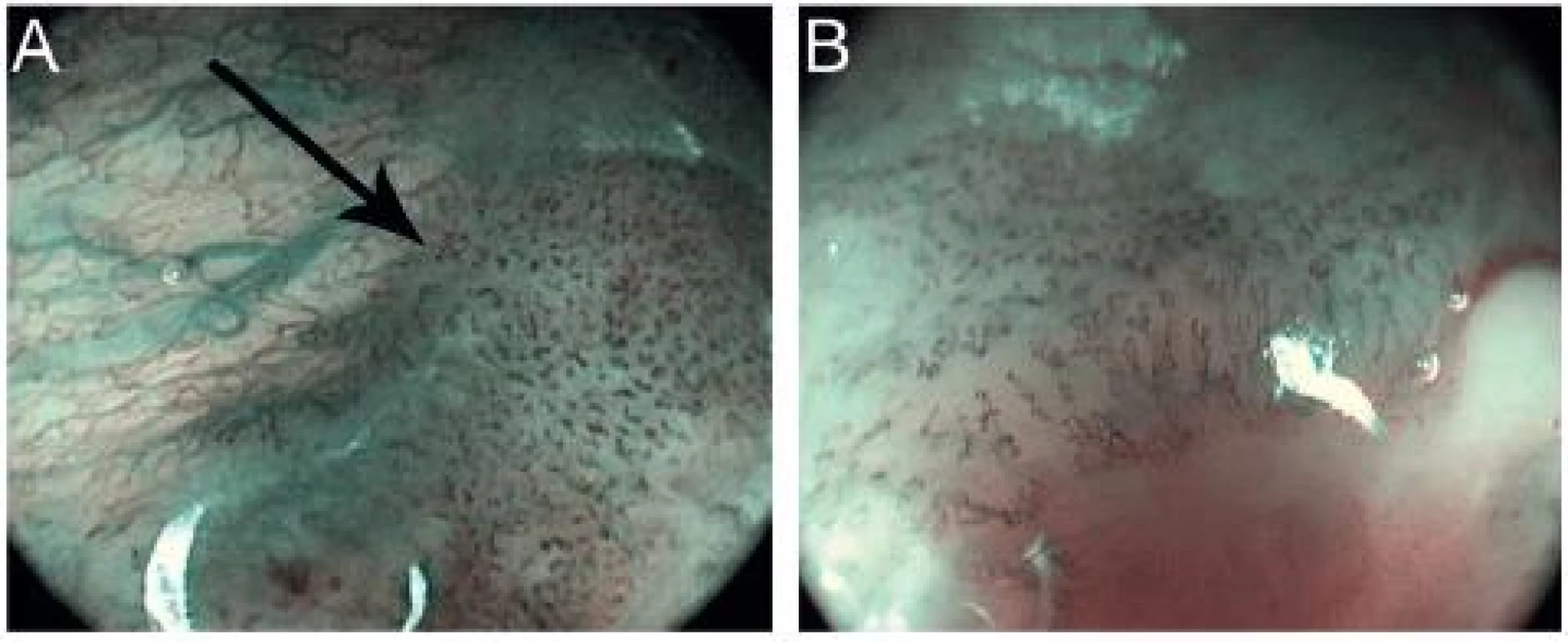 Pokročilý karcinom měkkého patra – HDTV NBI zvětšovací endoskopie. Dobře patrný přechod normální vaskularizace v nádorovou v okraji tumoru (šipka) (A) a rozpad cévní mikroarchitektury v centru tumoru (B).