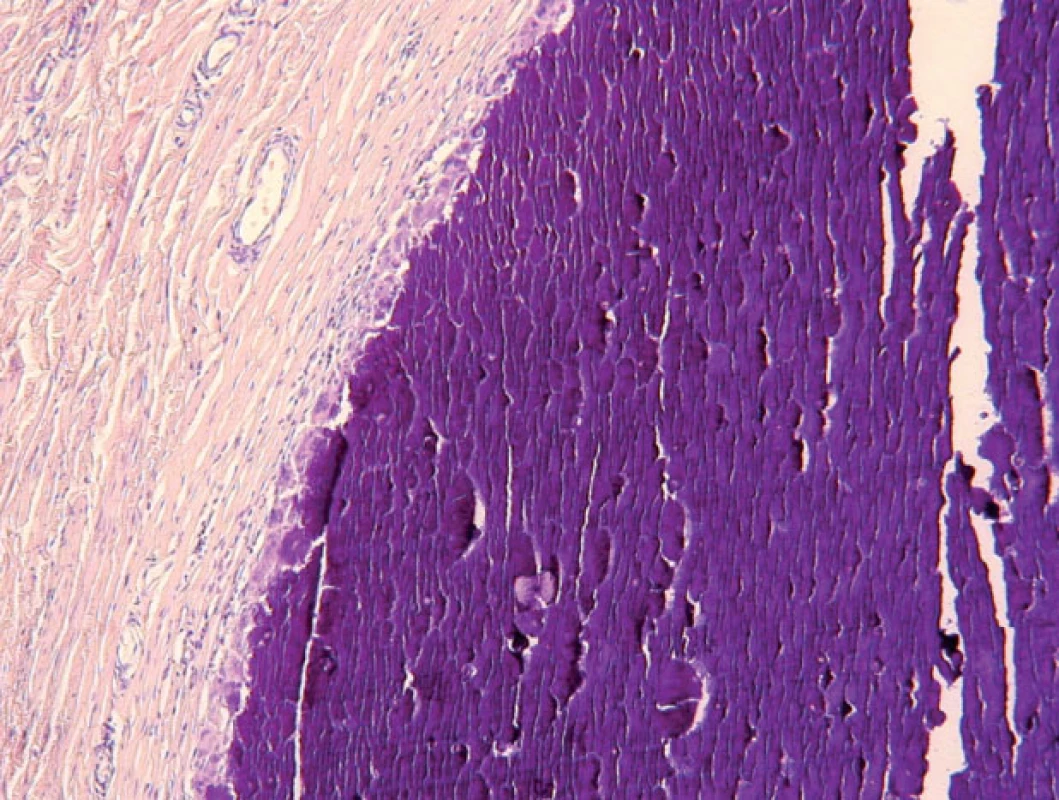 Histologický obraz – uzlovité depozity vápníka v derme (HE, 100x)