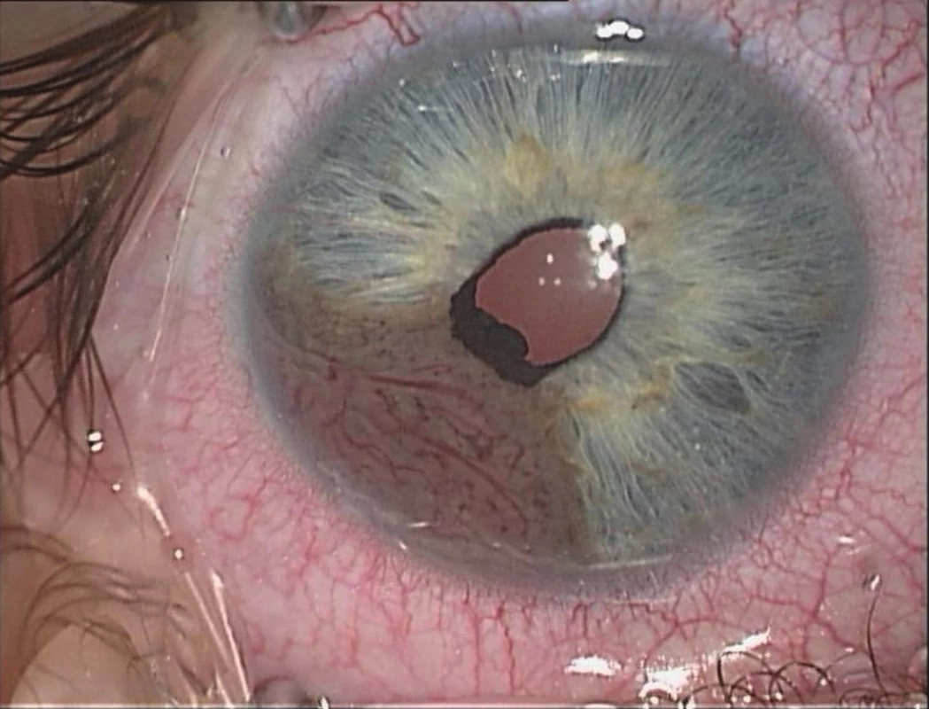 Melanom duhovky pravého oka na operačním sále těsně před resekcí
