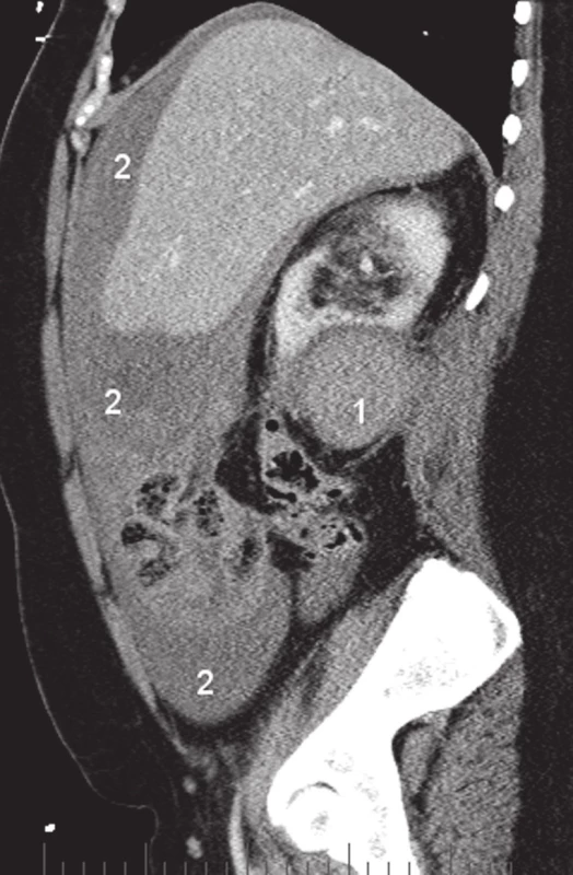 Rekonstrukce CT obrazu – tumor pravé ledviny (1) a hemoperitoneum (2)
Fig. 2. Reconstruction of the CT examination – right kidney tumor (1) and the haemoperitoneum (2)