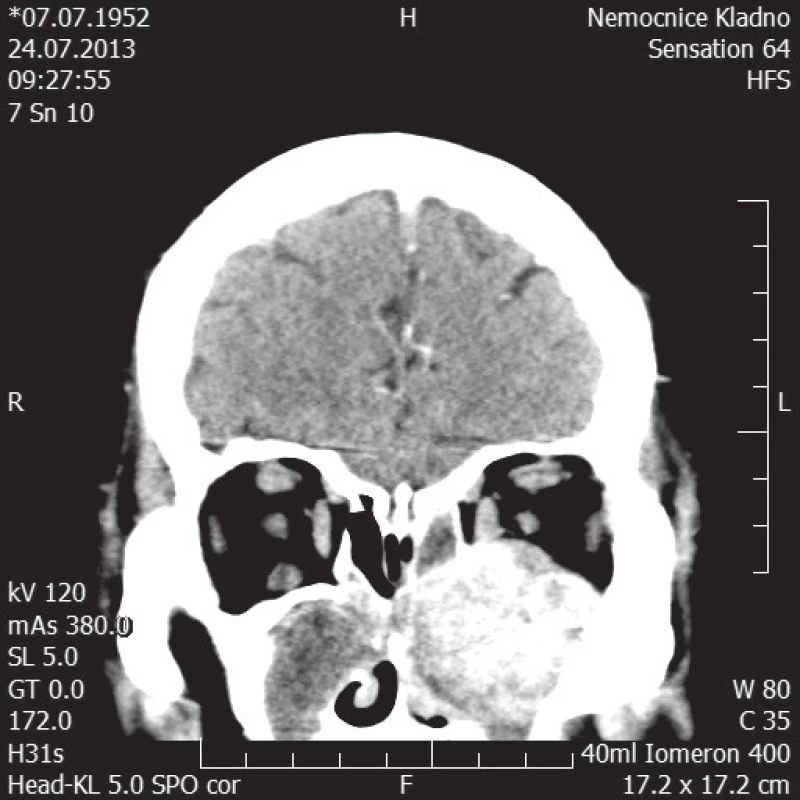 CT hlavy – koronární řez