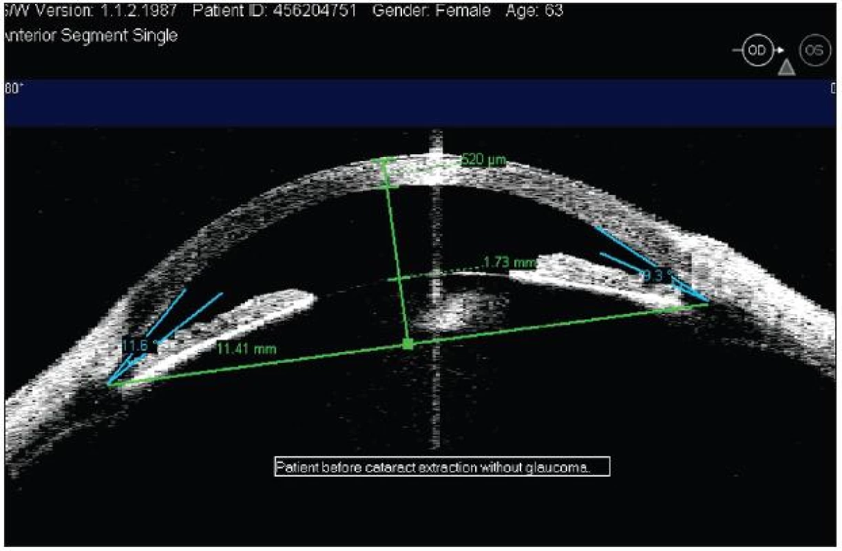 Hĺbka prednej komory a iridokorneálneho uhla u pacienta pred operáciou katarakty