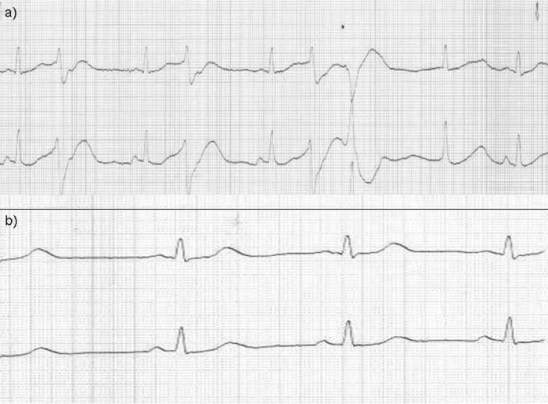 Elektrokardiogram znázorňující patologickou křivku s bigeminií jako obraz výrazné arytmie při intoxikaci theofylinem (a) a normalizace po zvládnutí akutního stavu (b)