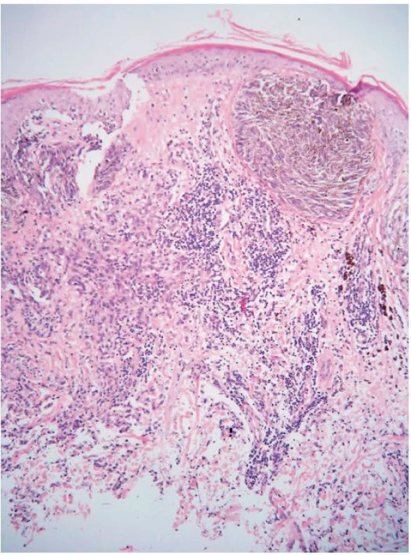 Detail předchozího obrázku (obr. 3)
Je zaměřený na jedno ze subepidermálních hnízd pigmentovaných vřetenitých melanocytů, v koriu jsou chaoticky uspořádané nepigmentované melanocyty a infiltráty lymfocytů (původní zvětšení 100x).