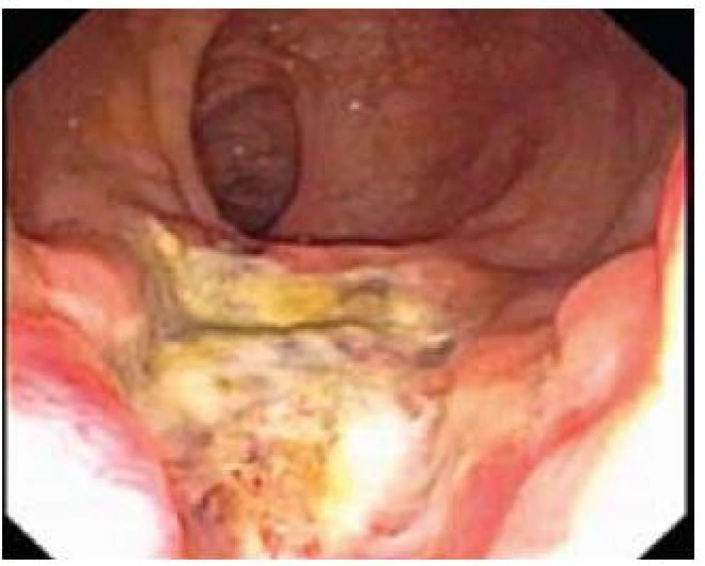 Ulcerózní forma.
Fig. 3. Ulcerous type.