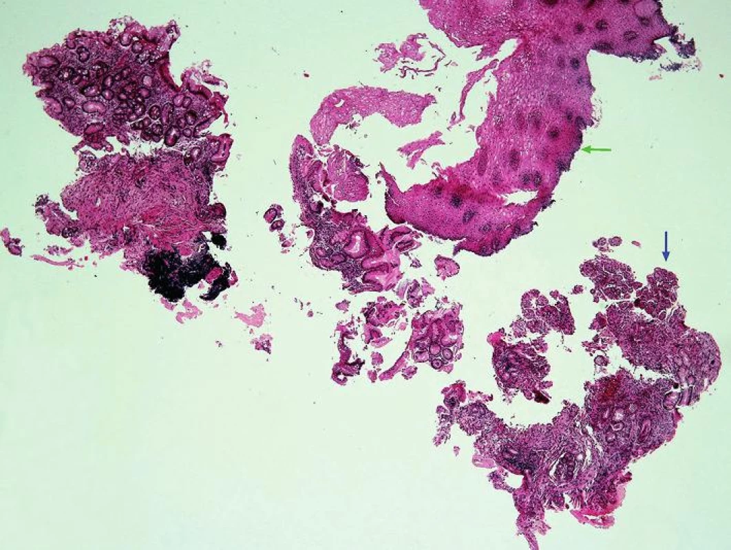 Přehledný obraz morfologických změn při refluxní ezofagitidě.