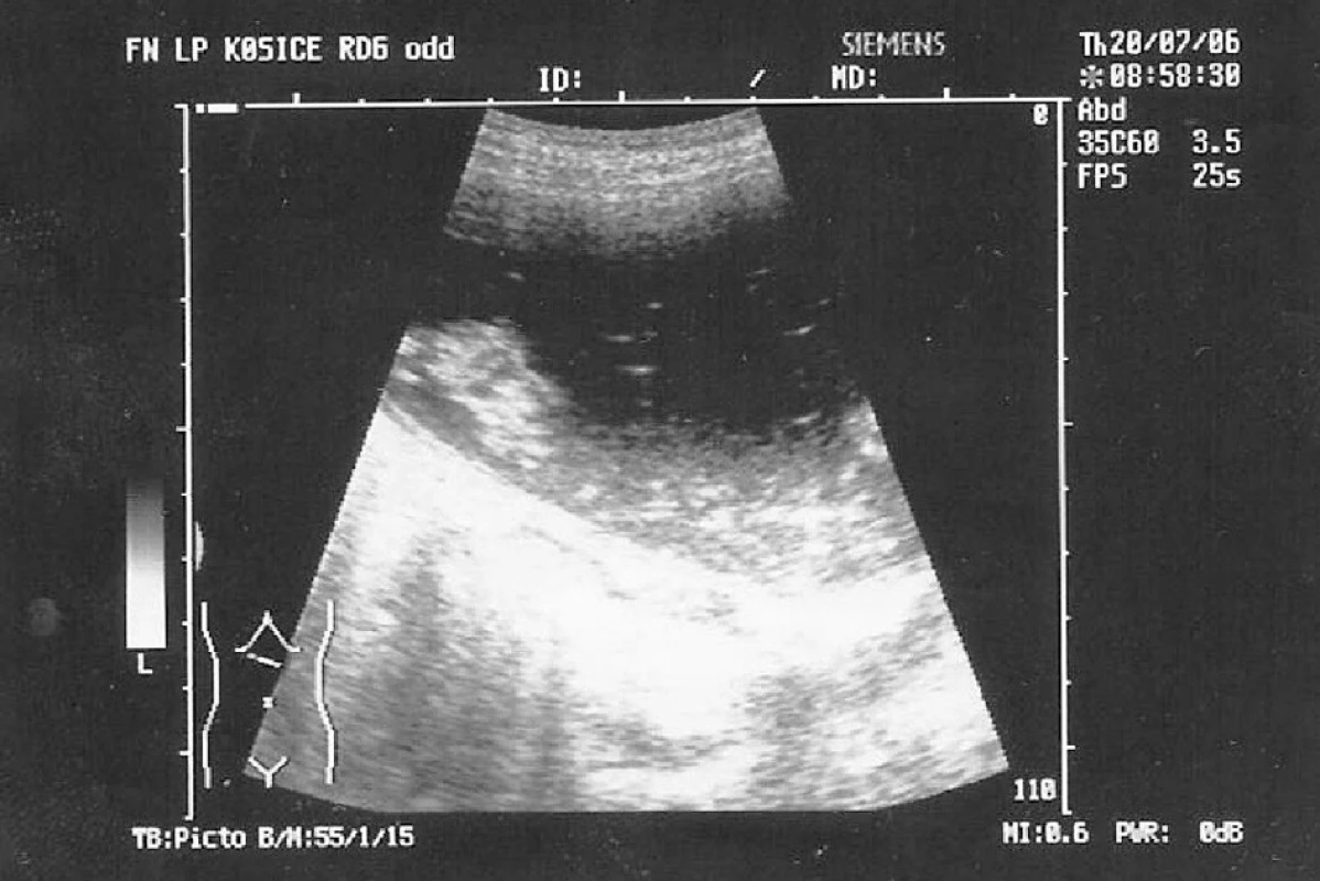 Ultrasonografia abdomenu – dilatácia žalúdka nad prekážkou
Pic. 4. Ultrasonography of abdomen – stomach dilatation above the obstruction