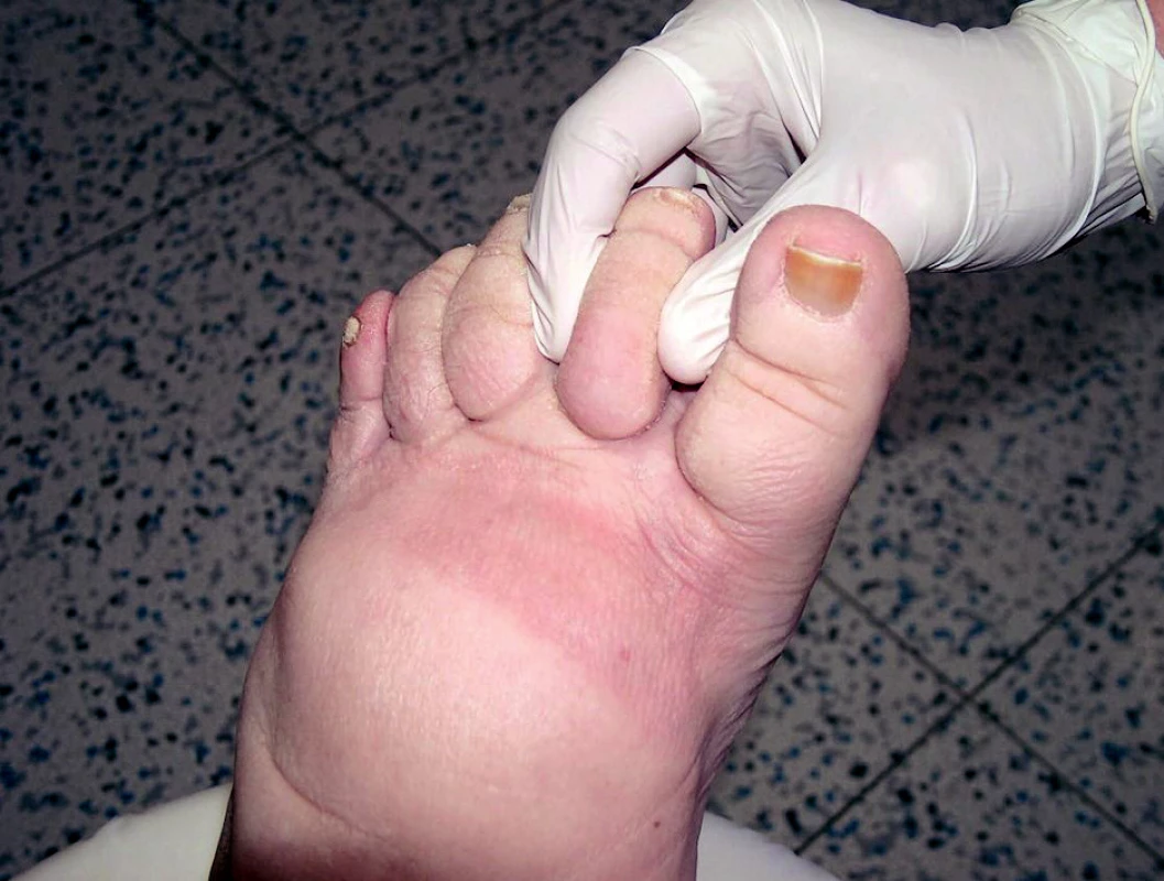 Stemmerovo znamení (na druhém prstu nohy nelze vytvořit kožní řasu).