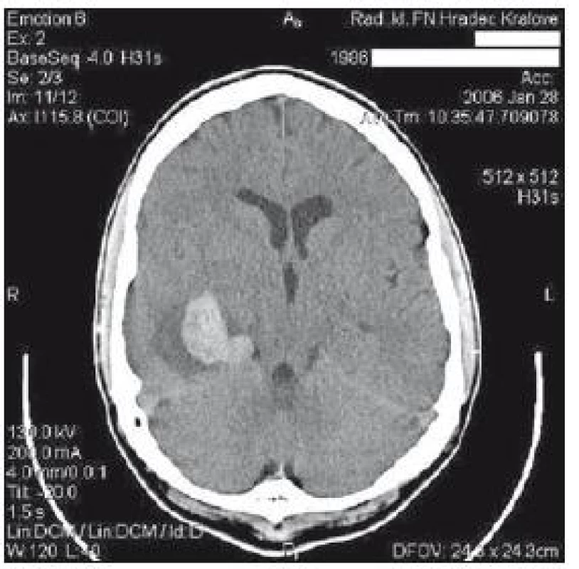 CT mozku z 28. ledna: hematom vpravo temporálně vel 34 × 40 × 70 mm s hypodenzním lemem, edém 1/3 pravé hemisféry.