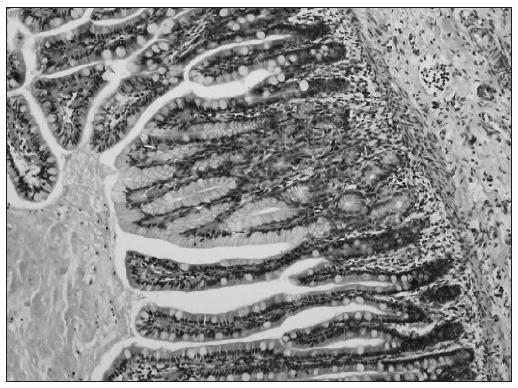 Sliznica Meckelovho divertikula, kde v strede obrázku je zachytená sliznica žalúdočného
typu s parietálnymi bunkami, ktorá na oboch stranách prechádza do sliznice tenkého čreva
(farbenie hematoxylín-eozín, zväčšenie 200x).
Fig. 2. Mucosa of Meckel diverticula, showing stomach-type mucosa in the middle of the picture with parietal cells, with transition, on both sides, into the mucosa of small intestine (staining with
hematoxylin and eosin, 200-fold magnification).