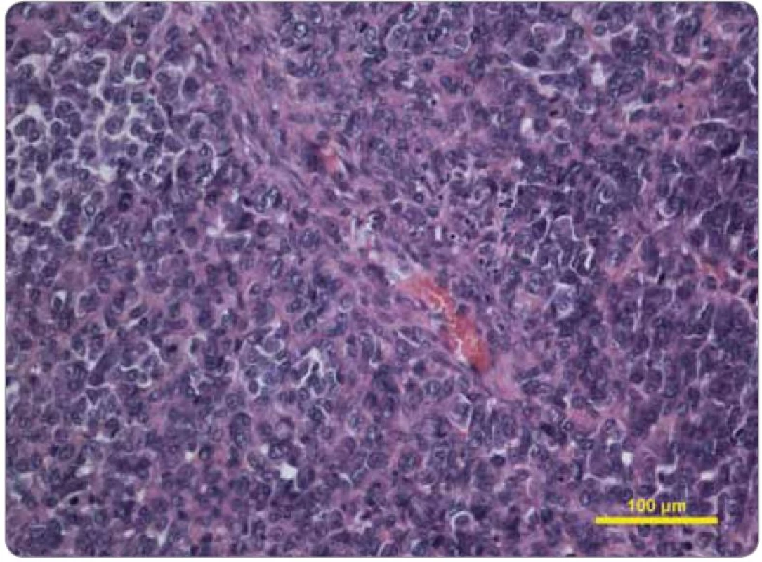 Histologický obraz tumoru hrudní stěny z ledna 2011, barvení hematoxylineozin, původní zvětšení 200×. Při vyšším zvětšení je místy patrné uspořádání v drobných vágních hnízdech, malé množství růžové eozinofilní cytoplazmy nádorových buněk. V centru snímku céva.