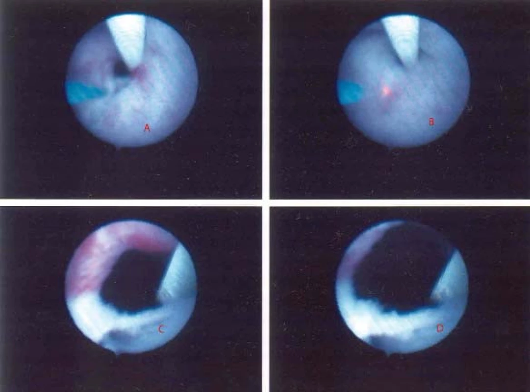 Flexibilní ureteroskopie a holmium laserová endoureterotomie primární UPJ obstrukce.
