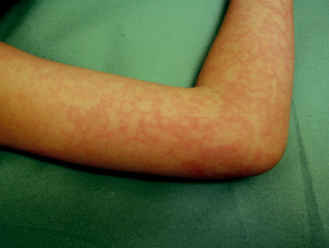 Erythema infectiosum, 9-ročný chlapec (parvovírus B19)