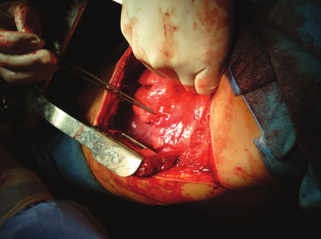 Perioperační nález sutura dolního laloku levé plíce
Fig. 7. Perioperative finding – left lower inferior lobe suture