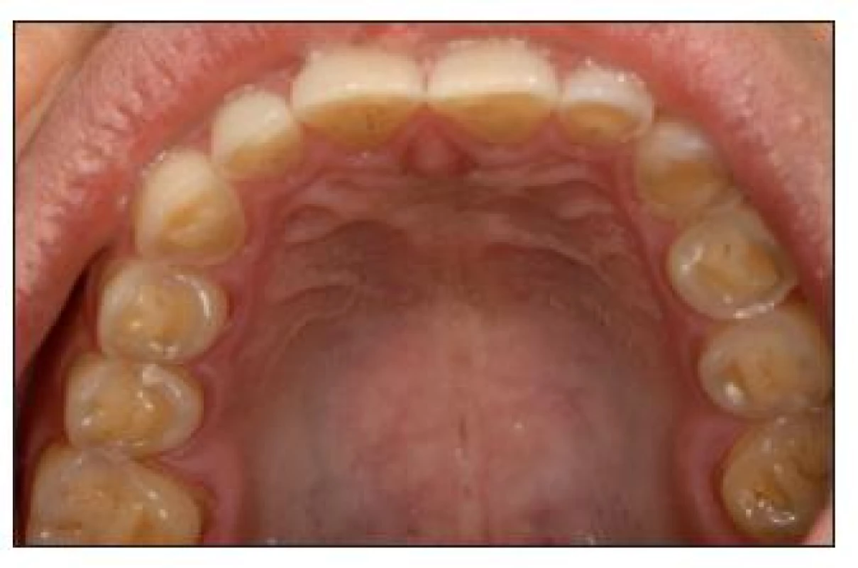 Pokročilé eroze na zubech horní čelisti