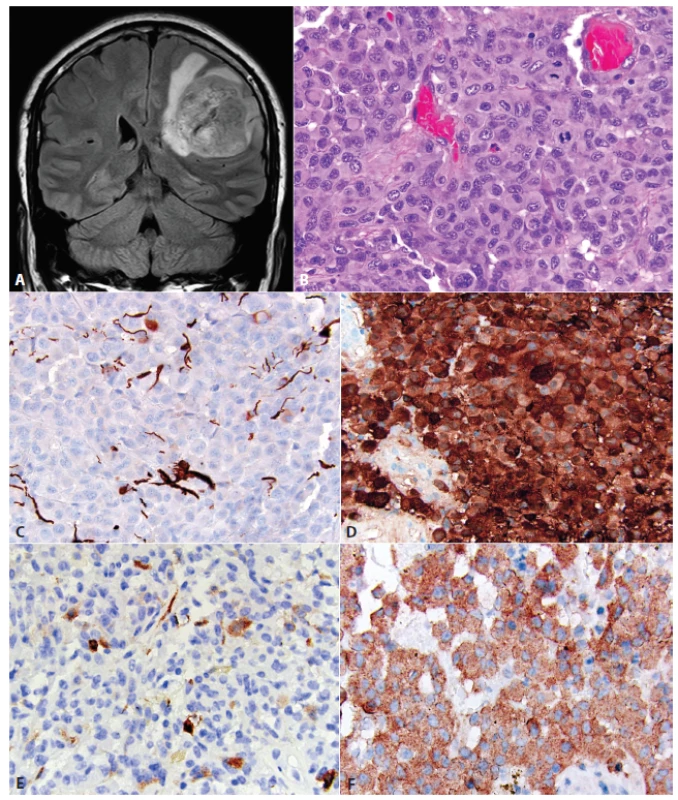 Epitelioidný glioblastóm (eGBM). MRI tumoru pravej frontoparietálnej oblasti u 21 ročnej ženy &lt;b&gt;(A)&lt;/b&gt;. Nádor bol tvorený monotónnou populáciou epiteloidných buniek s objemnou eozinofilnou cytoplazmou. Niektoré bunky mali rabdoidnú morfológiu, s excentricky uloženými jadrami a eozinofilnou cytoplazmatickou inklúziou (šípka, &lt;b&gt;B&lt;/b&gt;). Expresia GFAP v eGBM je často limitovaná na malú časť buniek, alebo môže byť kompletne negatívna &lt;b&gt;(C&lt;/b&gt;). Difúzna expresia S100 proteínu (alternatívny „gliálny“ marker). Ostatné melanoma-markery sú vždy negatívne &lt;b&gt;(D)&lt;/b&gt;. Častá je fokálna expresia „neuronálnych“ markerov, napr. neurofilamet proteínu &lt;b&gt;(E)&lt;/b&gt;. Difúzna expresia BRAF V600E mutovaného proteínu &lt;b&gt;(F)&lt;/b&gt;. Obrázky láskavo poskytol Arie Perry, Department of Pathology, Division of Neuropathology, University of California, San Francisco, USA.