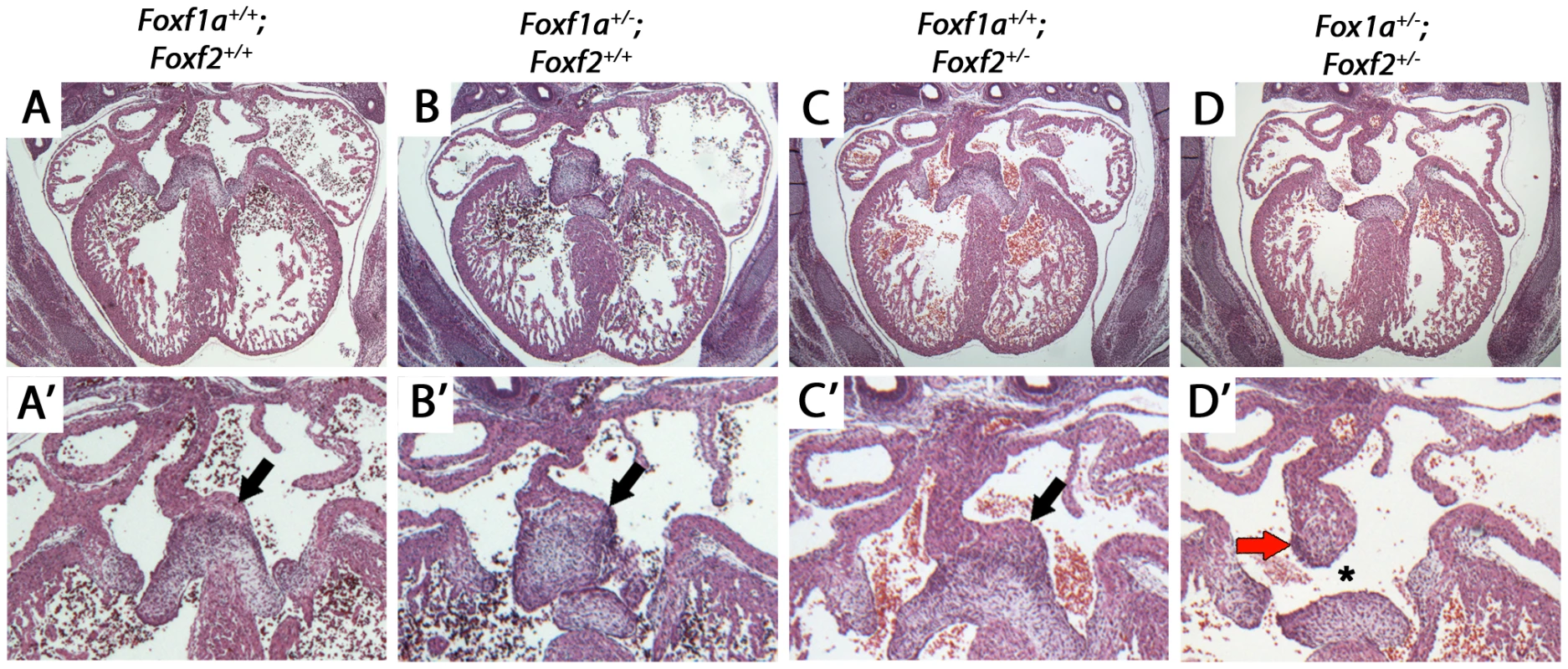 Atrioventricular septal defects in <i>Foxf1a<sup>+/−</sup>; Foxf2<sup>+/−</sup></i> compound heterozygote embryos at E14.5.