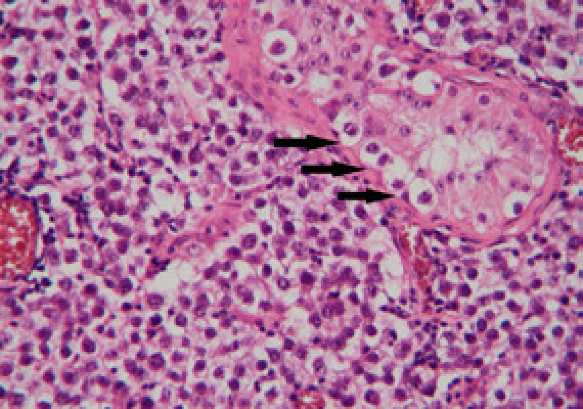 Detail histologického preparátu – vpravo nahoře kanálek s buňkami IGCNU (šipky), v okolí infiltrace klasickým seminomem (Hematoxylin – eosin, zvětšení 40 x, foto Radim Žalud)
Fig. 5. Detail of histological specimen – tubule with IGCNU cells (arrows), surrounded by seminoma (Hematoxylin – eosin, magnification 200 x, photo Radim Žalud)