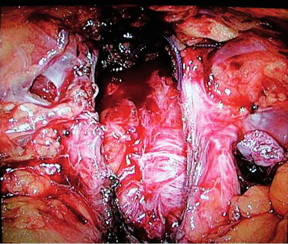 Lůžko po intrafasciální EERP
Fig. 1. Prostatic bed after intrafascial EERP