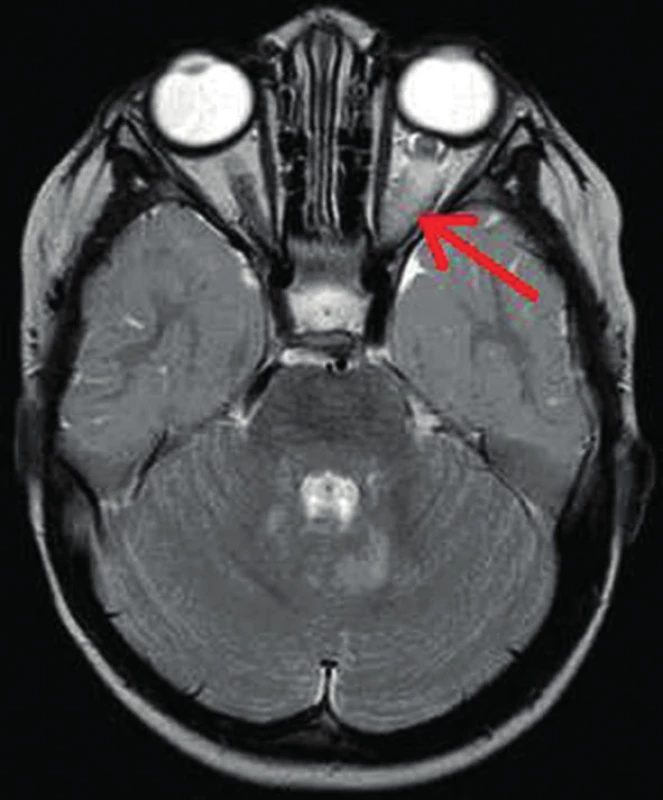 Gliom levého optiku intraorbitálně (šipka) na MR vyšetření mozku v T2 vážených obrazech u 2letého chlapce 
Současně zjištěna hypersignální ložiska mozečku v okolí IV. komory.