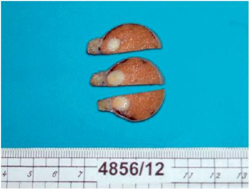 varletem s patrným intraparenchymovým nádorem
Fig. 2. Crossection of the testis with intraparenchymal tumor