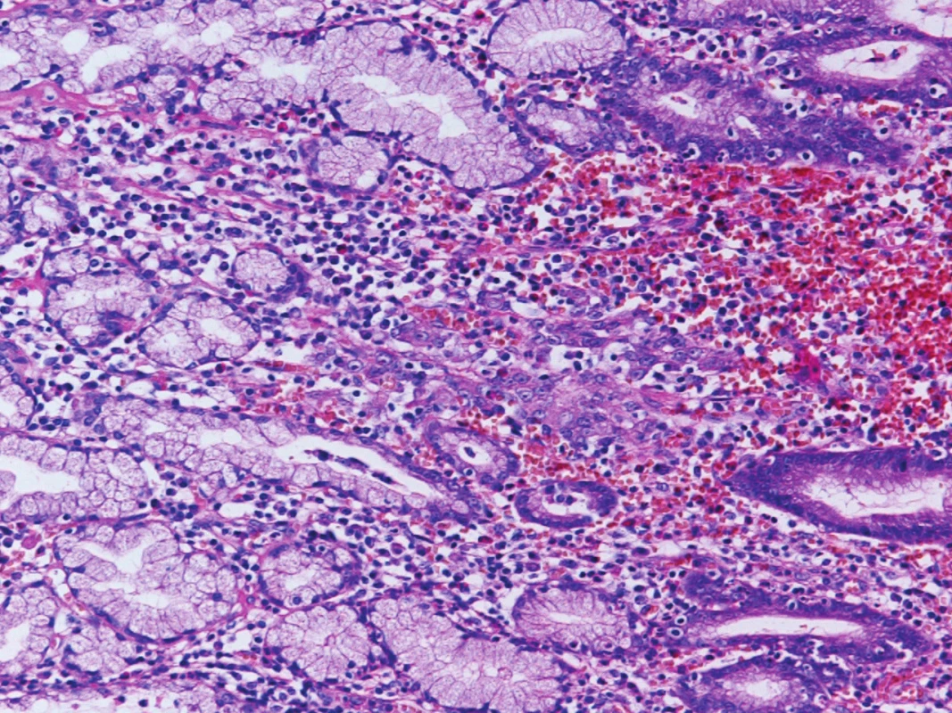 Skupina karcinomových buněk (uprostřed) ve sliznici žaludeční Originální zvětšení 200x, HE (hematoxylin, eosin).
Fig. 2: Group of cancer cells (in the middle) in gastric mucosa Original magnification 200x, HE (haematoxylin, eosin