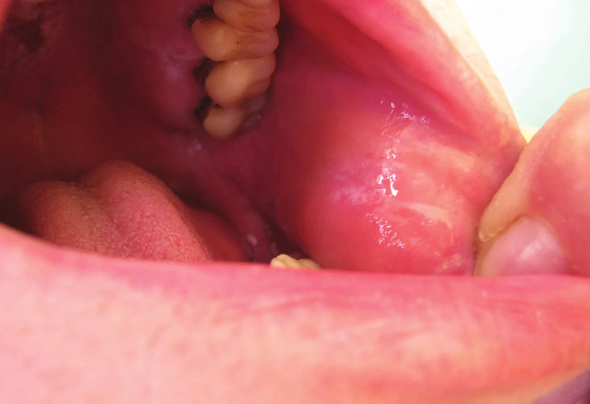 Alergická kontaktní stomatitida lichenoidního typu v dutině ústní po amalgámu