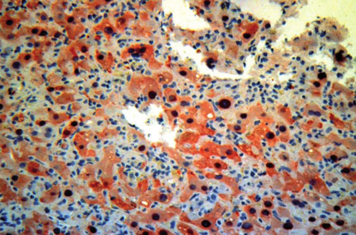 Autoimunitní hepatitis – mikroskopický obraz.