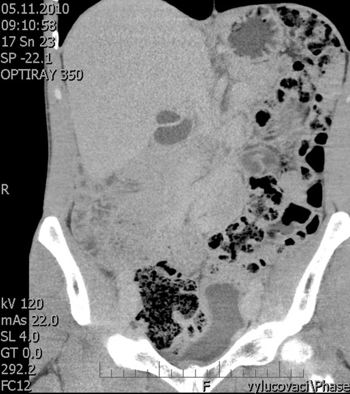 CT obraz – dva cystické útvary v subhepatální oblasti
Fig. 1: CT image – two cystic lesions below the liver