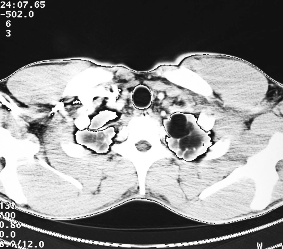 CT scan – emfyzematózní buly v apexu levé plíce
Fig. 1. CT scan – emphysematous bullae in the left pulmonary apex 
