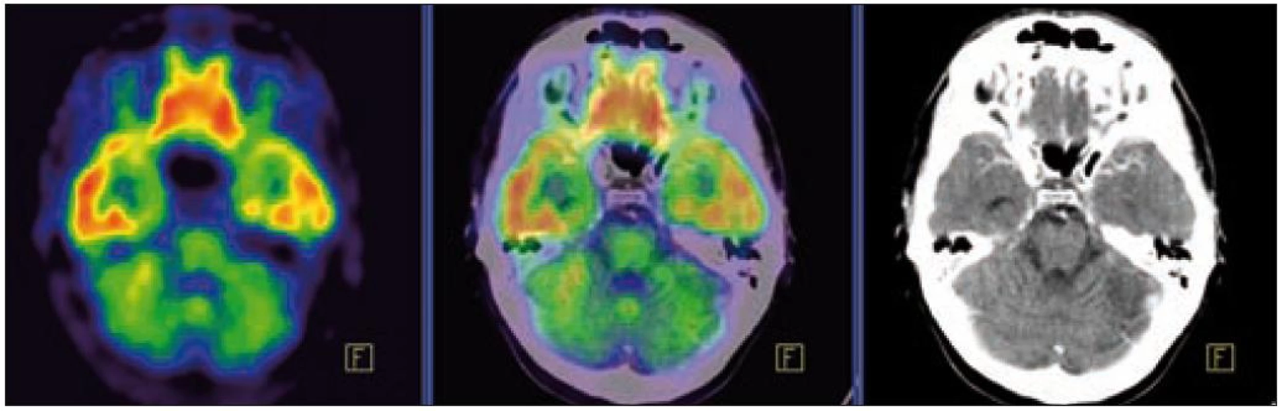 PET – low dose CT mozku. Snížená akumulace fluorodeoxyglukózy v oblasti cerebella, sagitální projekce atrofické změny cerebella v CT zobrazení.