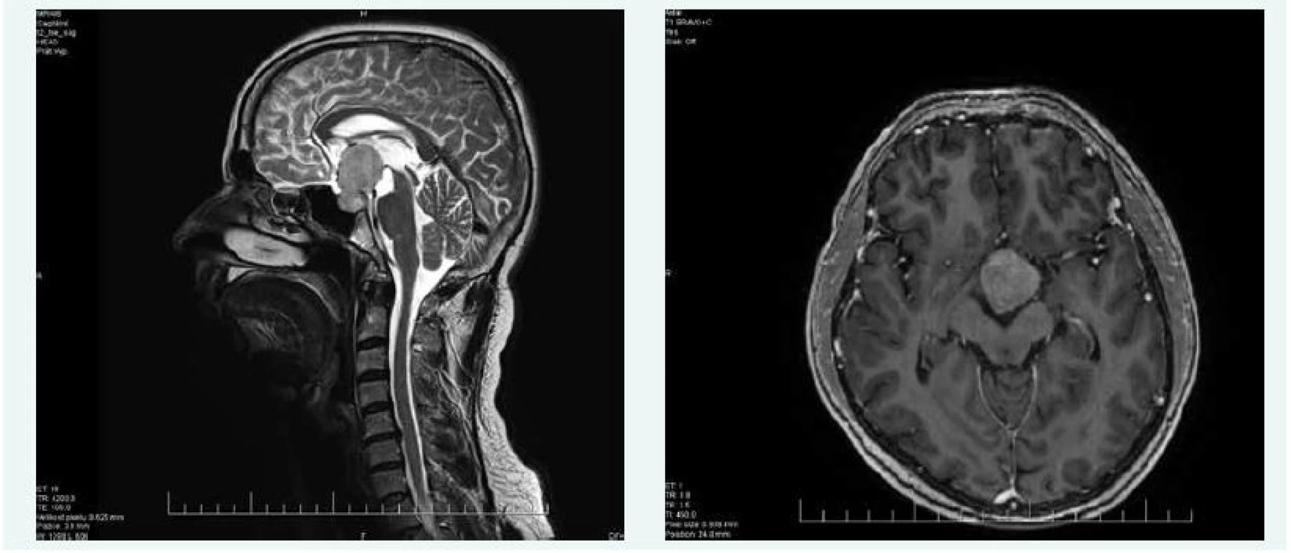 Kazuistika 2 – makroadenom hypofýzy (MRI) (snímky v plném rozlišení naleznete v on-line verzi článku)