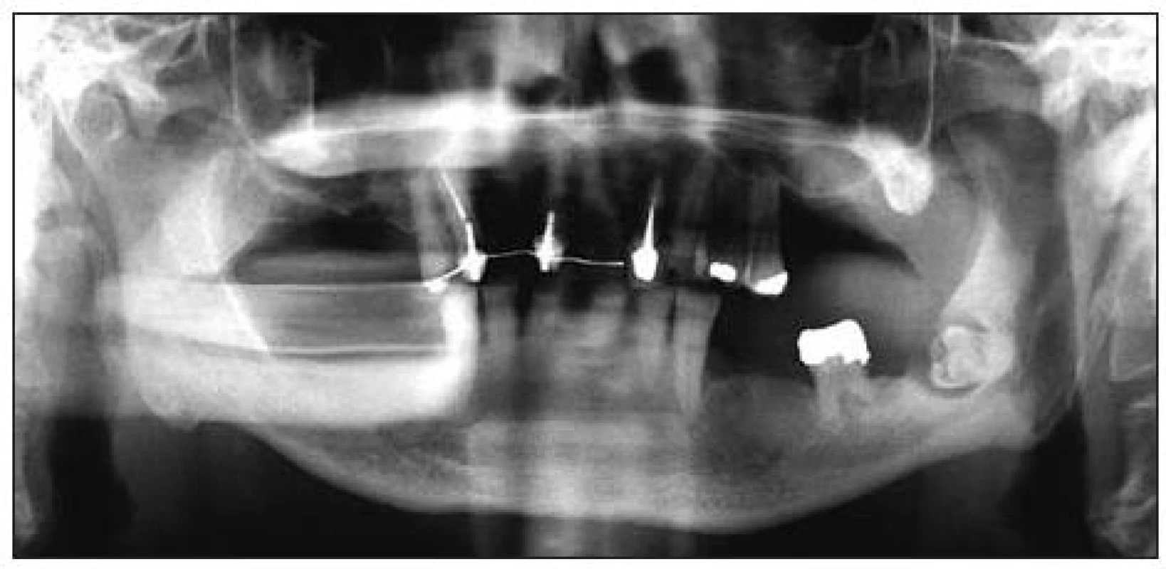 Ortopantomogram s dobře viditelným projasněním kolem korunkové části retinovaného zubu 38