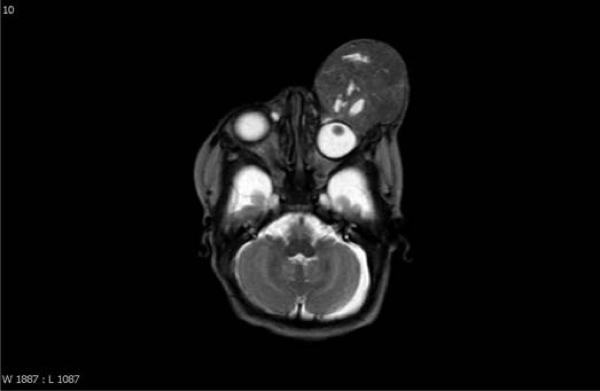 MR mozku – 22. den po narození, velikost útvaru 47 x 42 x 59 mm.