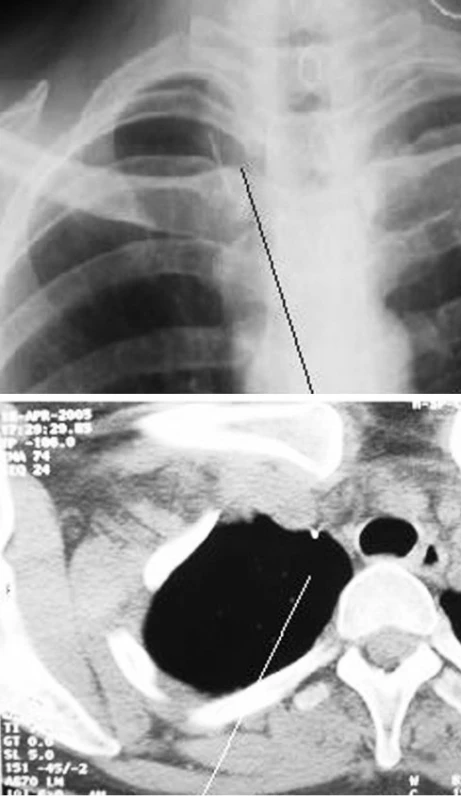 RTG obraz cizího tělesa v horní hrudní apertuře, CT-obraz
Fig. 5. An x- ray view of the foreign body in the upper thoracic aperture, a CT scan