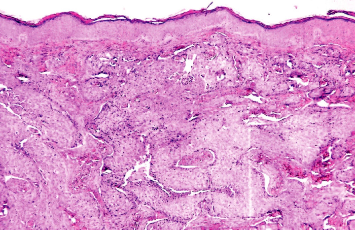 Histologický obraz metastázy adenokarcinomu cervixu v koriu (HE, 100x).