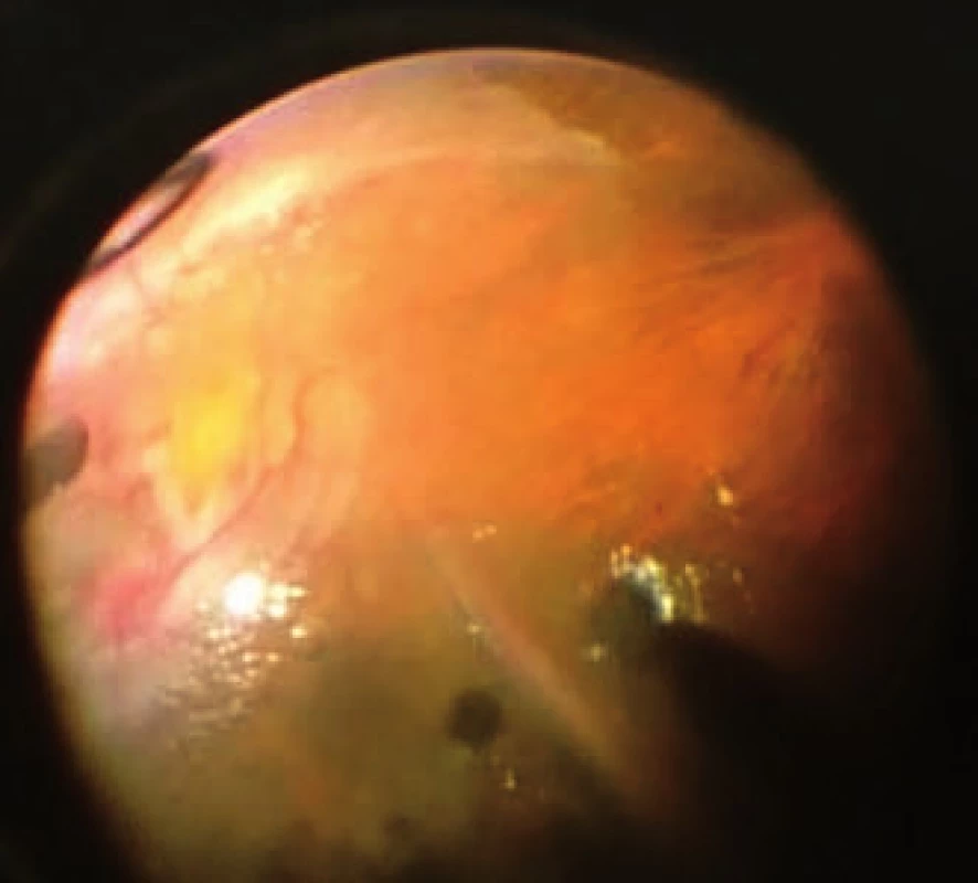 Snímek z peroperačního videa (z pohledu chirurga): retina je ošetřena 360st retinotomií, výměna dekalinu za silikonovou tamponádu, retina kolem papily a v makulopapilárním svazku je foldovaná, makula distopicky rotována dolů